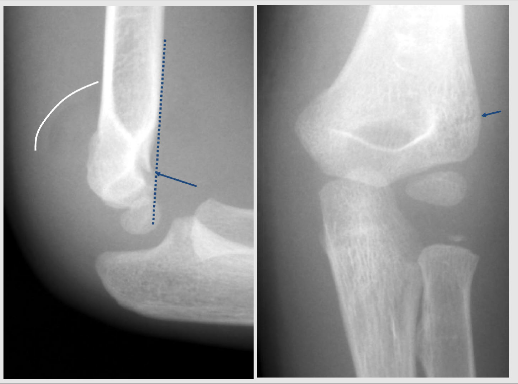 supracondylar fracture xray